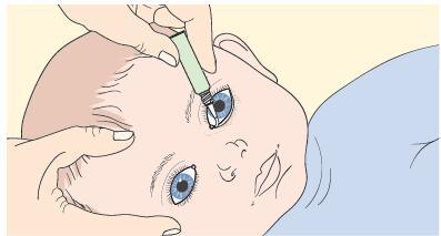 Eye Ointment at Birth: A Dated Tradition