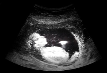 18 Week Fetus Yawns in Utero!