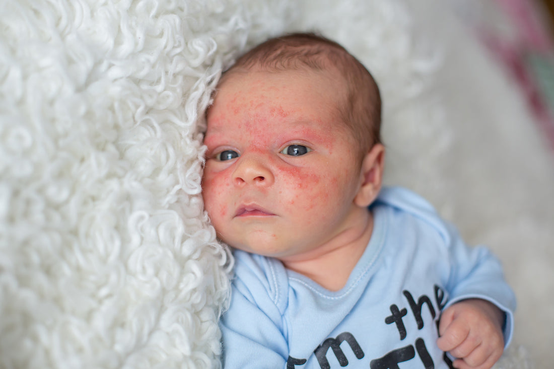 Baby Acne: Causes and Treatments