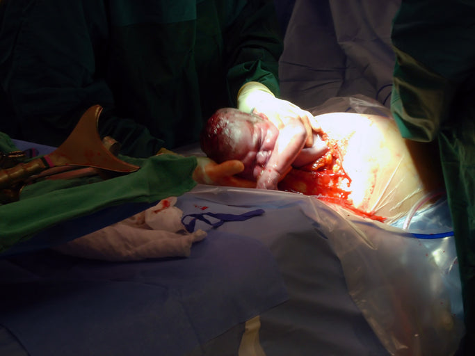 3 Common Reasons for an Unplanned C -Section - My Baby's Heartbeat Bear